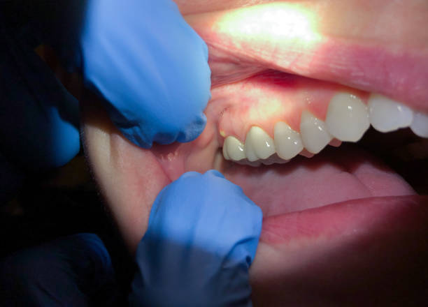 Best Emergency Dentist for Lost Fillings or Crowns in Metamora, IL